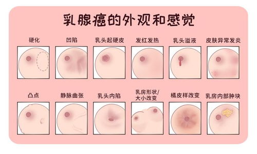 女子爱生闷气诱发乳腺肿瘤达15厘米