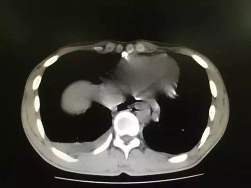 男子吃饭狼吞虎咽把食管吃破了