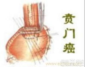 汽车贲门多少钱 汽车贲门多少钱